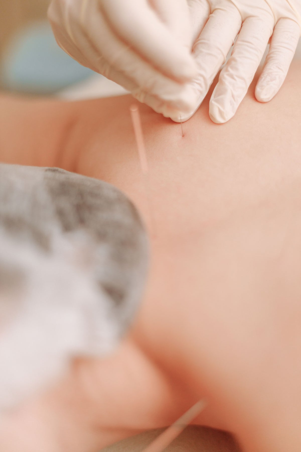 What acupuncture may support